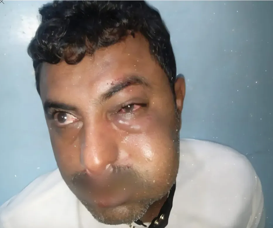 قيادي حوثي يعتدي بالضرب على محامٍ في مدينة زبيد بالحديدة